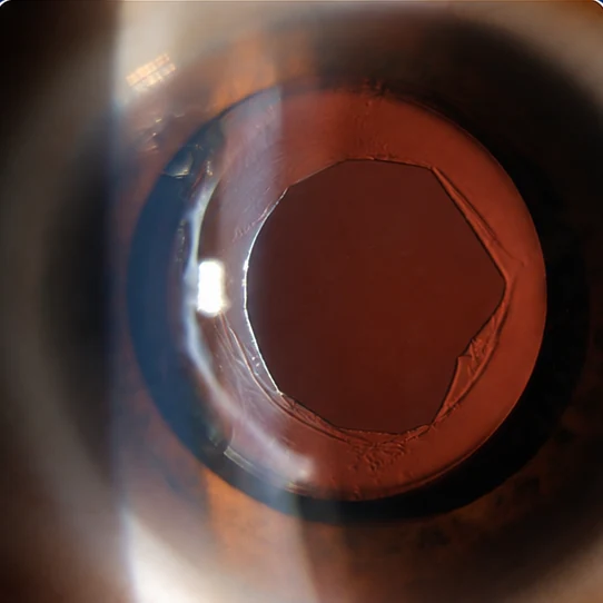 Retroiluminação do mesmo olho após o laser: uma janela central aberta na cápsula deixa o reflexo alaranjado do fundo do olho passar.